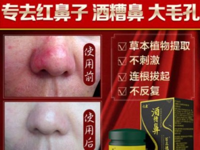 了解以下巴螨虫的病因及预防方法（探究以下巴螨虫感染的原因及预防措施，保护您的健康）