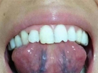 舌头发白的原因及相关健康问题（探究舌头发白的原因，了解其与健康的关系）