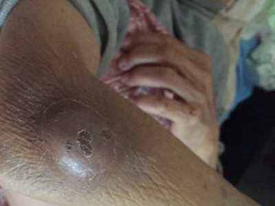 小腿上鼓了大包硬的应该挂什么科？（寻找正确的诊疗科室，及时解决小腿上大包的问题）