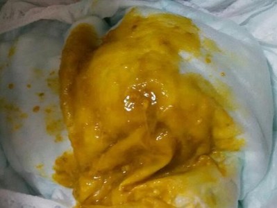拉肚子的颜色变化及其健康含义（引起拉肚子的常见颜色及其相关症状解读）