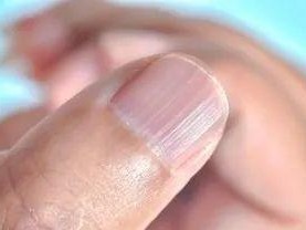 猫咪甲癣症状揭秘——如何识别和治疗（深入了解猫咪甲癣的各种表现和治疗方法）