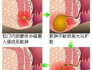 肛门粘液（探索肛门粘液的颜色变化及其健康意义）