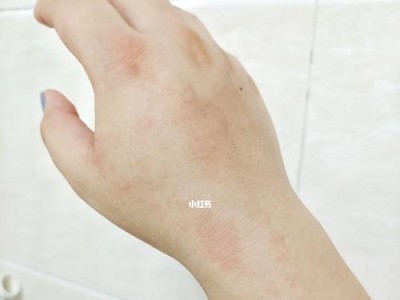 猫过敏（了解猫过敏的常见症状，保护自己和宠物的健康）