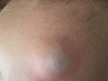 头上长个大包，可能是什么原因？（头部肿胀的常见病因及治疗方法）