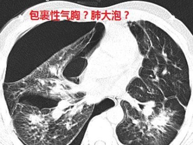 小狗气胸的症状、治疗和预防措施（详解小狗气胸的危害以及应对方法）