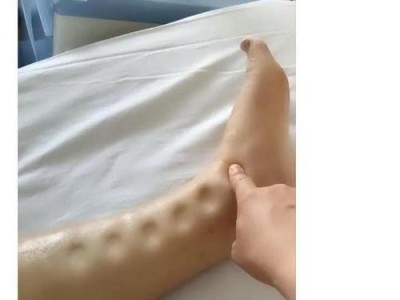 狗狗小孢子菌的治疗方法（选择合适的药物来处理宠物犬感染小孢子菌的问题）
