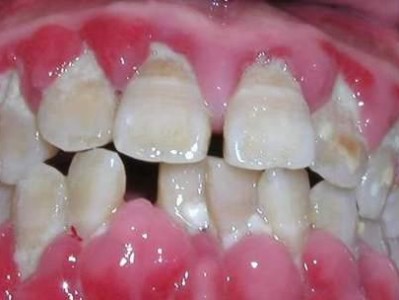 了解以牙结石的症状，保护你的口腔健康（探索牙结石的症状及如何预防）