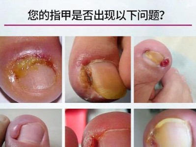 探究狗狗得甲沟炎的原因及预防措施（狗狗甲沟炎的症状和治疗方法）