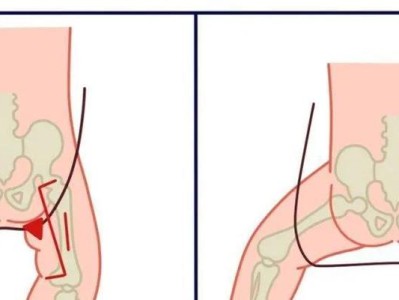 大腿断了要注意什么？（康复训练与饮食调整是关键）