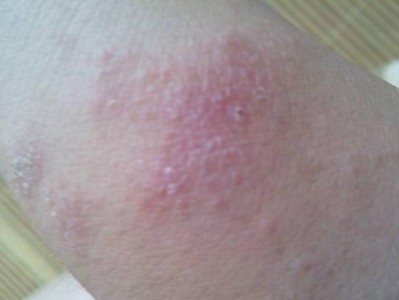 如何有效治疗宠物湿疹？（解决宠物湿疹问题的有效措施）
