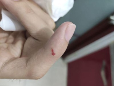 猫咬伤！探讨猫咬伤对人体的影响及应对方法（掌握猫咬伤的防范知识，保护自己和宠物的健康）