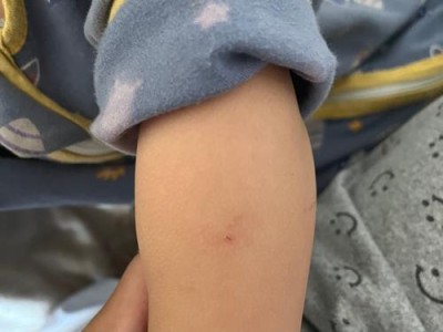 夏季蜱虫高发，了解蜱虫病的症状及预防措施（保护自己，远离蜱虫的威胁）